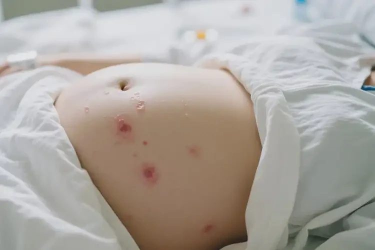 產(chǎn)婦肚子上偶爾起濕疹可不可以根治(圖4)