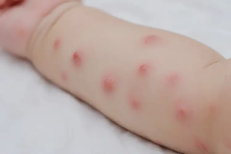 幼兒手臂偶爾長濕疹可不可以根治(圖4)