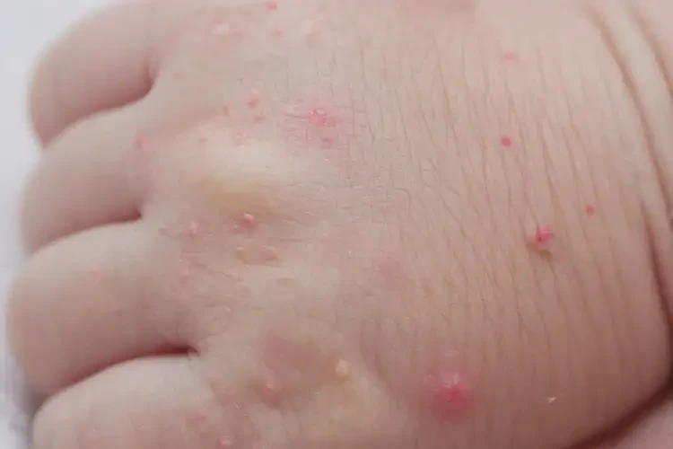 新生兒手上經(jīng)常起濕疹可不可以根治(圖4)