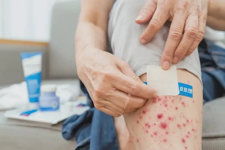 哺乳期媽媽大腿出現(xiàn)濕疹能不能根治(圖4)