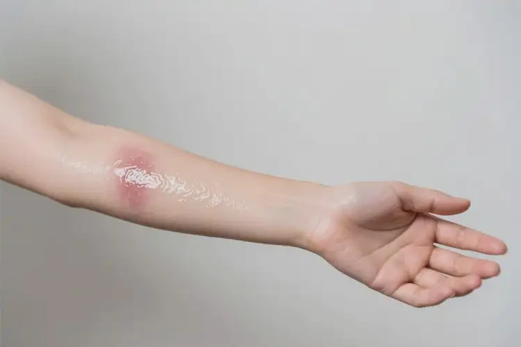 女生手臂上偶爾長(zhǎng)濕疹可以徹底自愈嗎(圖1)