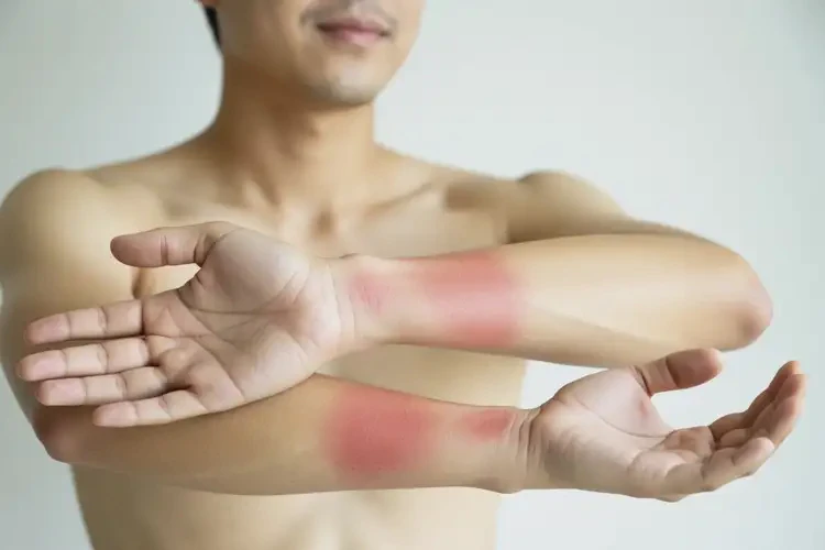 男人四肢出現(xiàn)濕疹能不能根治(圖4)