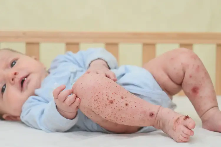 寶寶大腿偶爾起濕疹可不可以根治(圖4)