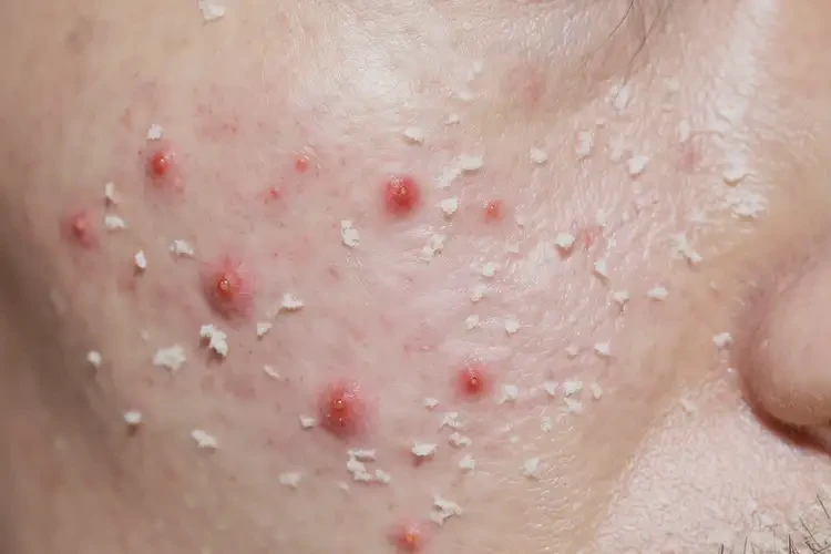 男人屁股上經(jīng)常長(zhǎng)濕疹能不能根治(圖4)