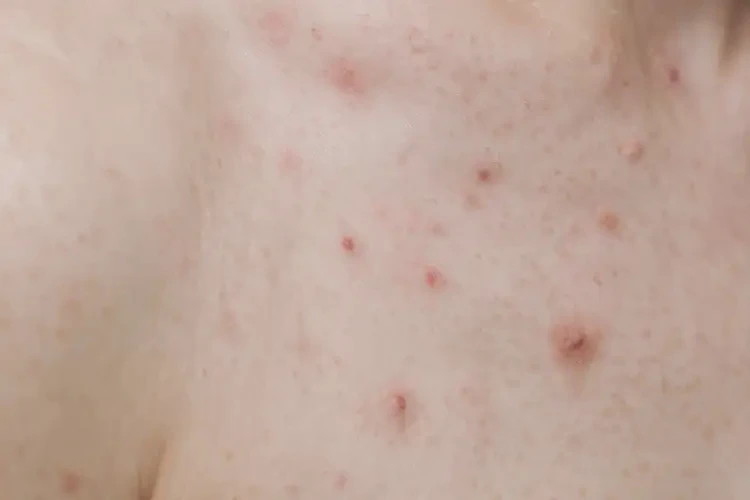 产妇脖子经常起湿疹可不可以根治(图4)