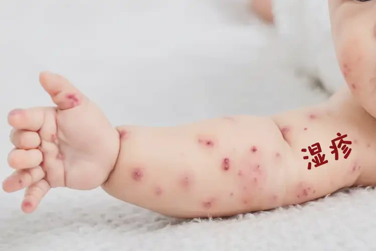 嬰兒四肢起濕疹可不可以徹底自愈(圖4)
