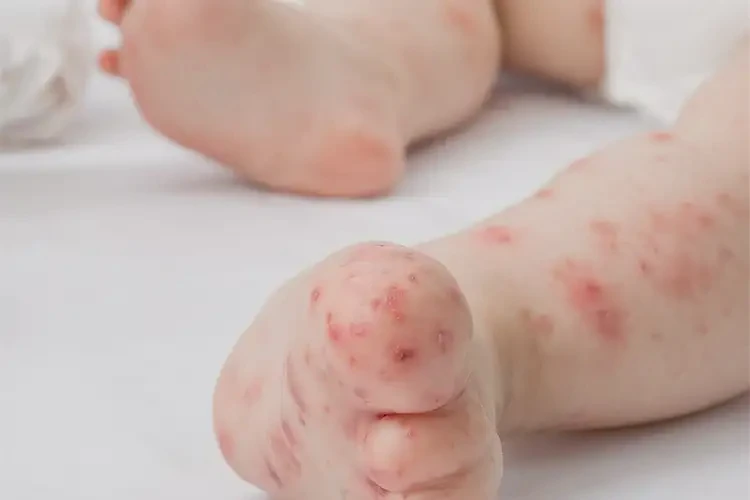 幼兒四肢偶爾長濕疹可不可以徹底自愈(圖4)