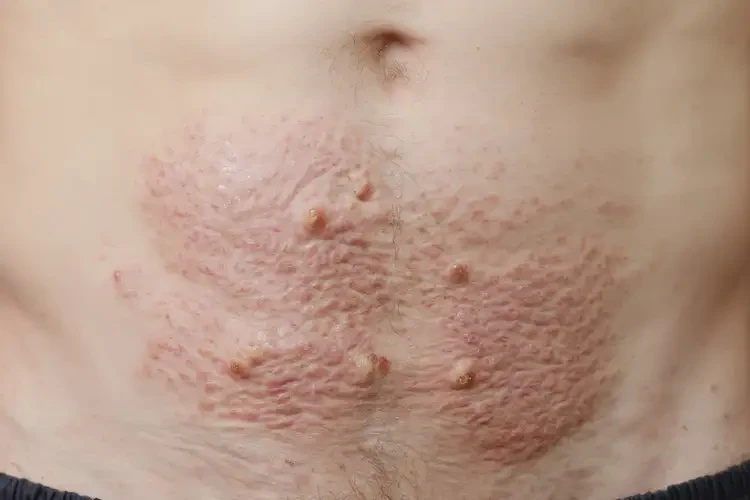 青年人肚子出濕疹能徹底自愈嗎(圖2)