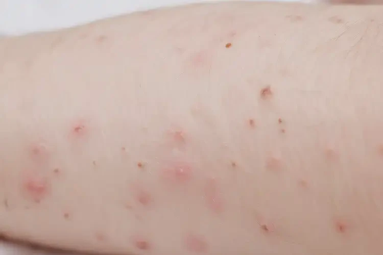 寶寶手上偶爾長濕疹不管它會自己好嗎(圖4)