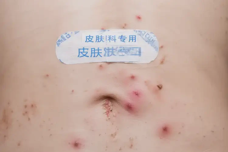 女人屁股上出现湿疹能不能根治(图4)