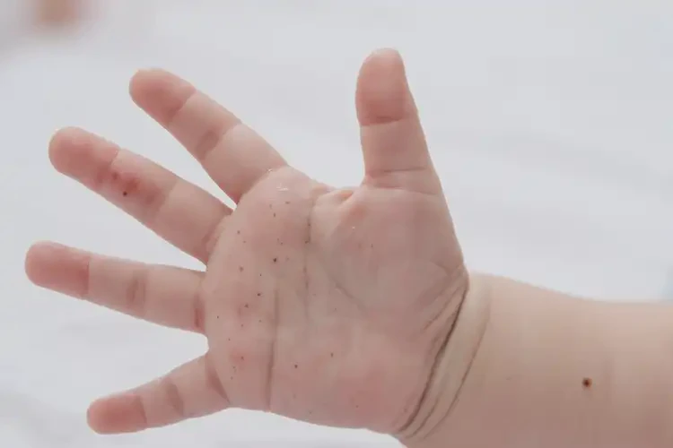 寶寶手上偶爾長濕疹可不可以根治(圖4)