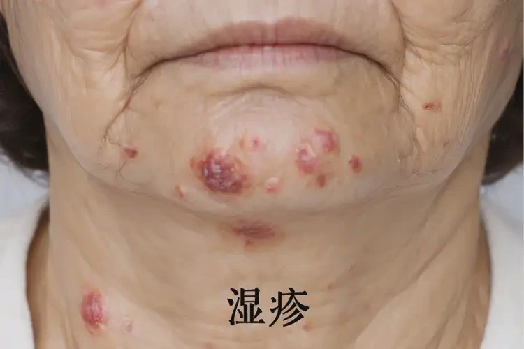 女生脖子偶爾起濕疹可不可以根治(圖4)