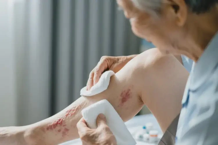 高齡老人小腿出濕疹能不能根治(圖3)