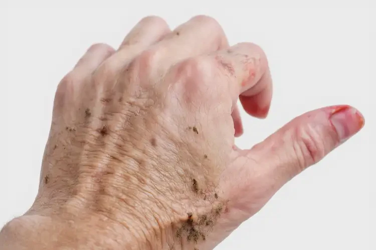 女生四肢出現(xiàn)濕疹能靠自己自愈嗎(圖2)