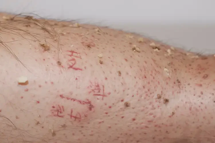 男人小腿上起濕疹能不能根治(圖3)