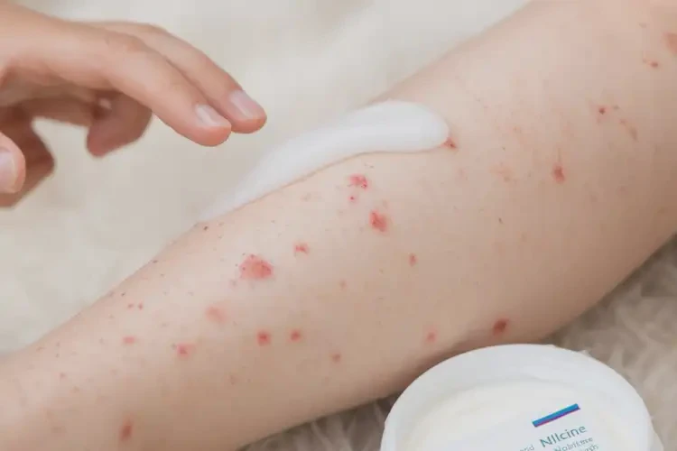 小孩小腿起濕疹可以徹底自愈嗎(圖3)