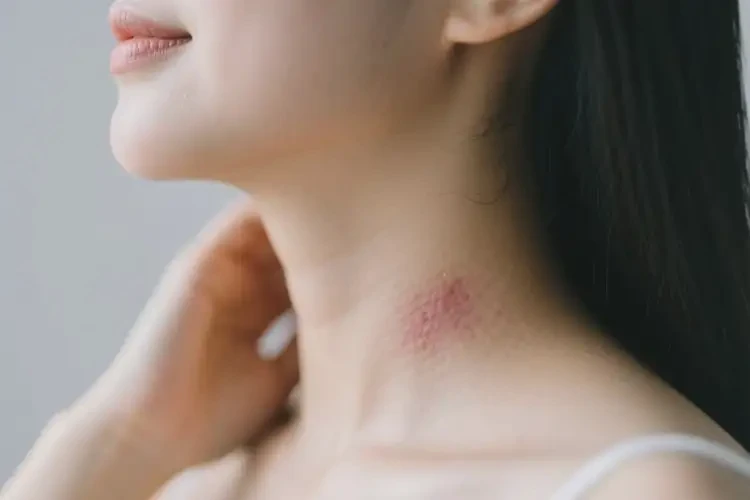 孕婦脖子上容易長(zhǎng)濕疹可不可以根治(圖3)