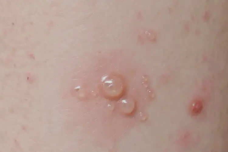 男人脖子容易起濕疹能不能根治(圖4)