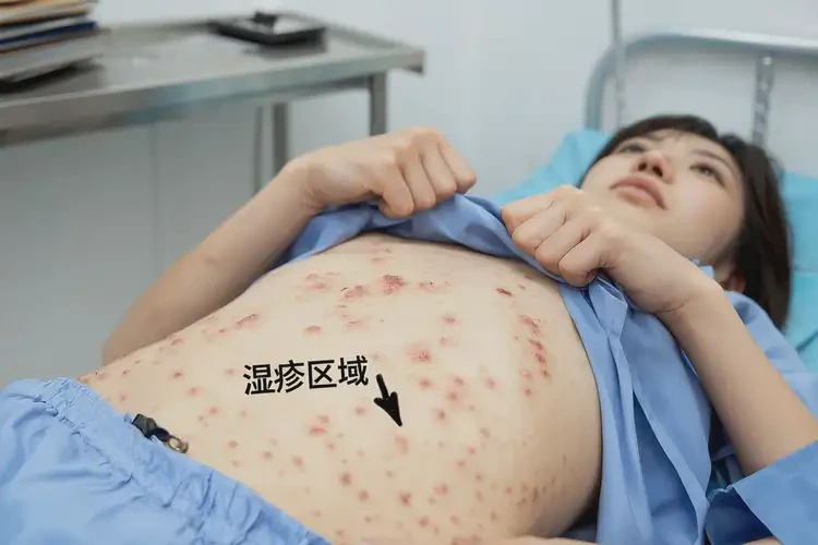 女人肚子長濕疹能不能根治(圖4)
