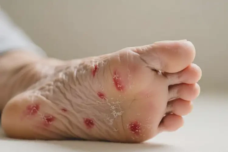 老人腳上偶爾長濕疹可不可以根治(圖4)