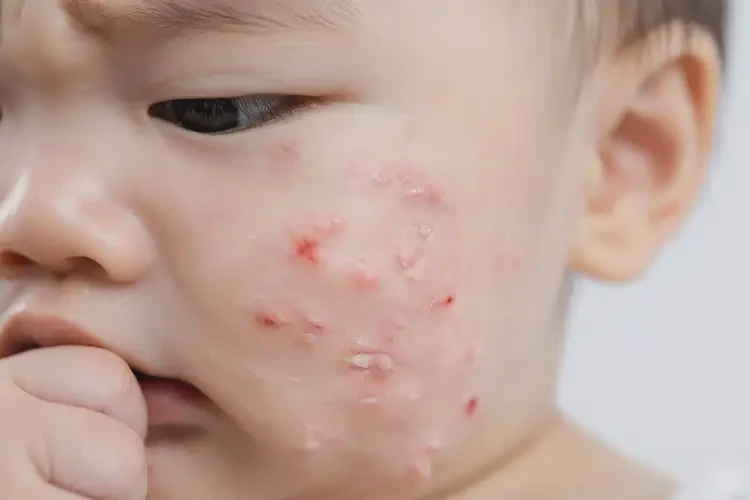 幼兒面部起濕疹可不可以根治(圖4)