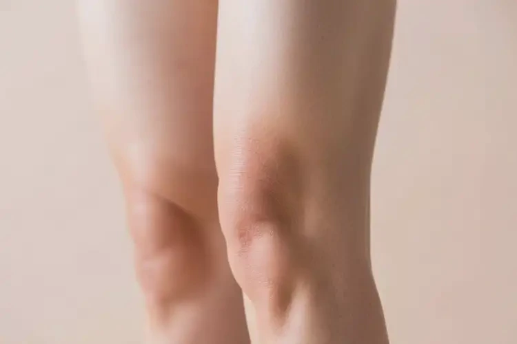 女人大腿上長濕疹能不能根治(圖4)