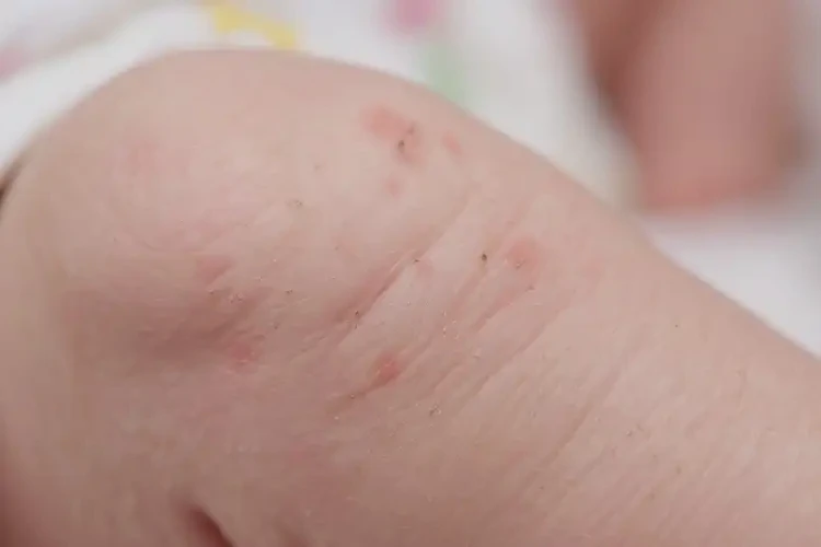 新生兒大腿上出現(xiàn)濕疹能徹底自愈嗎(圖4)