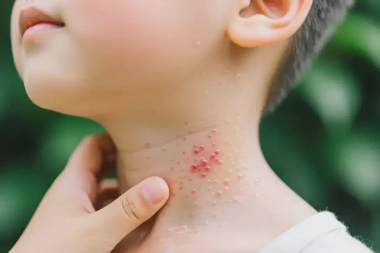 小學(xué)生脖子上容易長濕疹能不能徹底自愈(圖3)