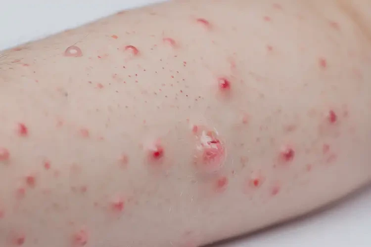 小孩手臂經(jīng)常長濕疹可不可以根治(圖4)