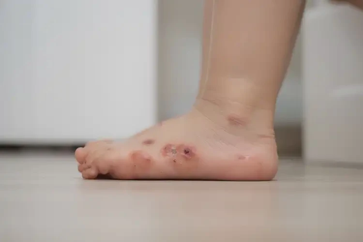 少兒腳上偶爾長濕疹不管它會(huì)自己自愈嗎(圖2)