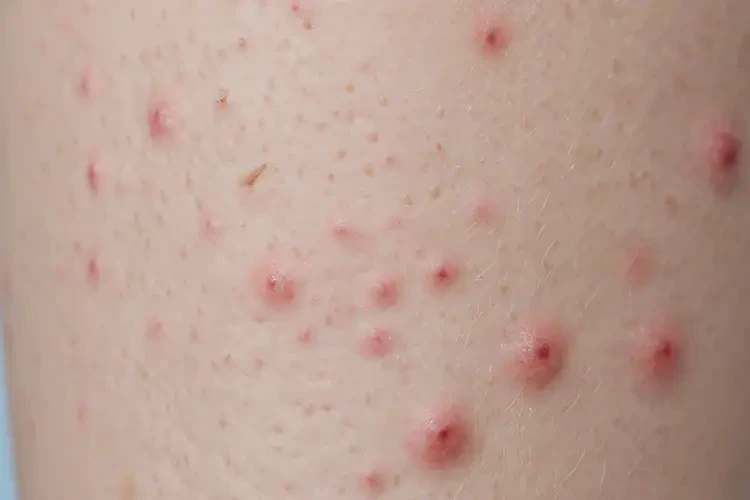 青少年小腿上偶爾起濕疹可不可以根治(圖4)