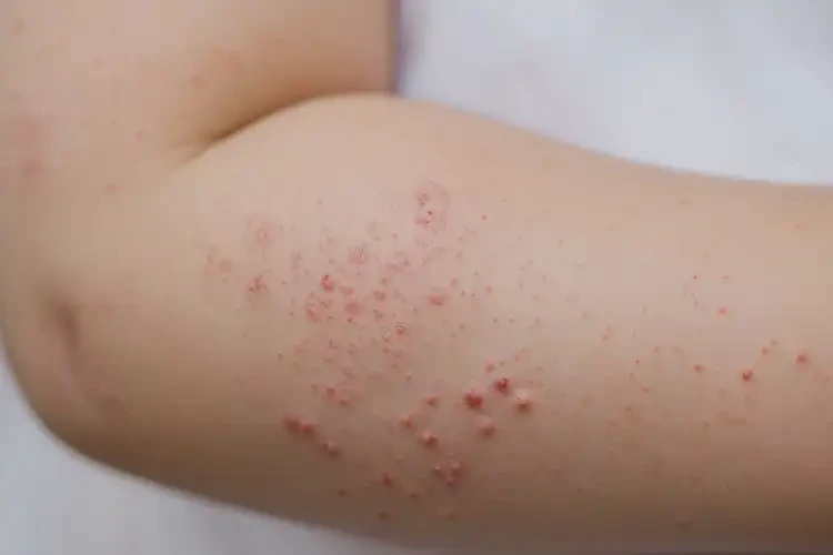 小兒四肢容易起濕疹可不可以根治(圖4)