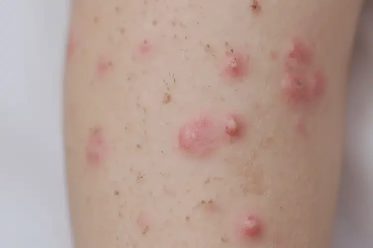 孩子四肢经常起湿疹可以彻底自愈吗(图4)