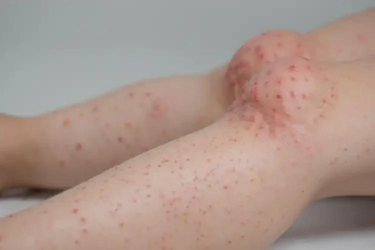 孩子大腿偶爾起濕疹可不可以根治(圖4)