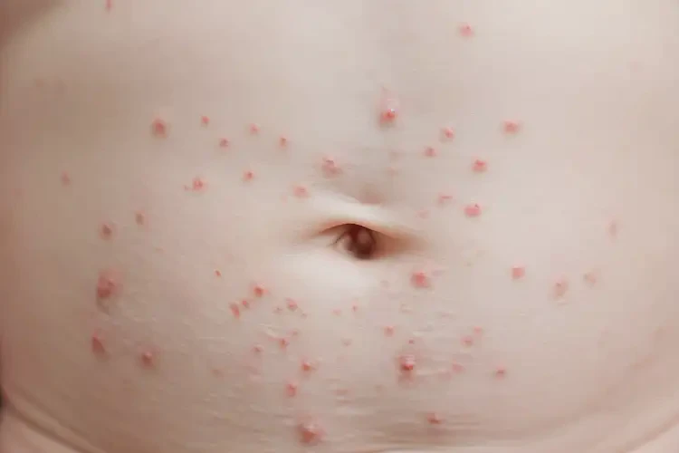 新生儿肚子经常长湿疹可不可以根治(图3)