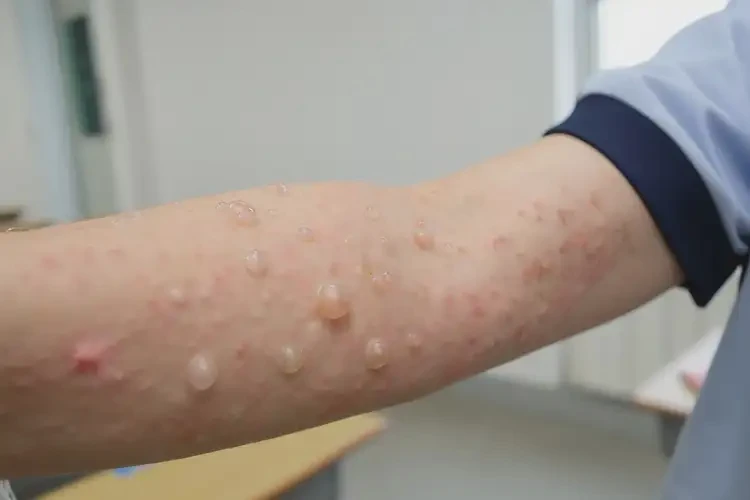 中學(xué)生手臂上容易長濕疹能靠自己自愈嗎(圖3)