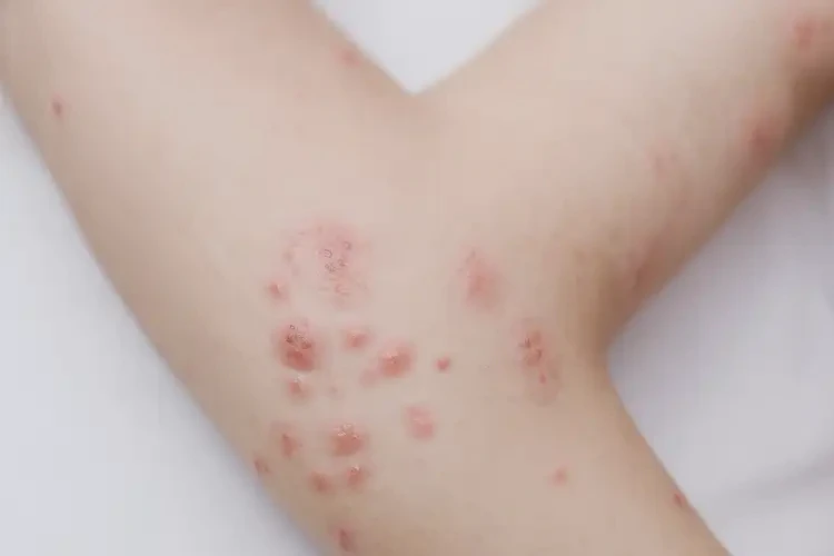 儿童四肢长湿疹不管它会自己痊愈吗(图4)