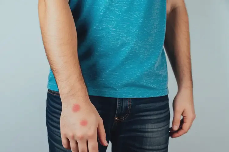 男性四肢偶爾長濕疹能靠自己自愈嗎(圖3)