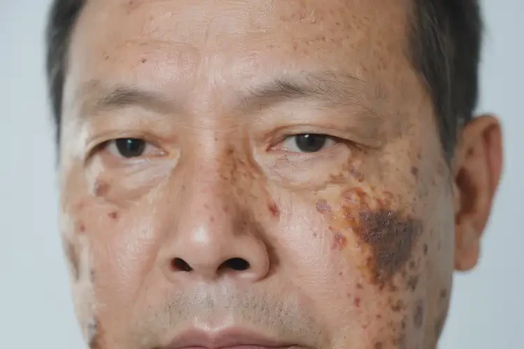 青年人肚子出現(xiàn)濕疹可以徹底自愈嗎(圖3)