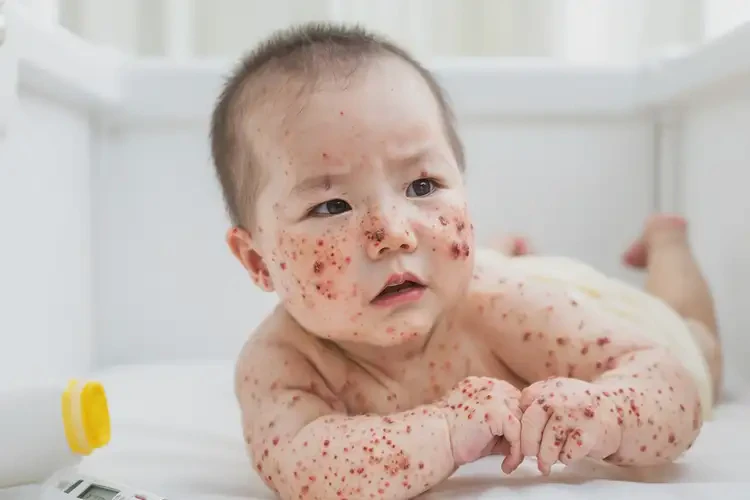 寶寶屁股上偶爾長濕疹可不可以根治(圖4)
