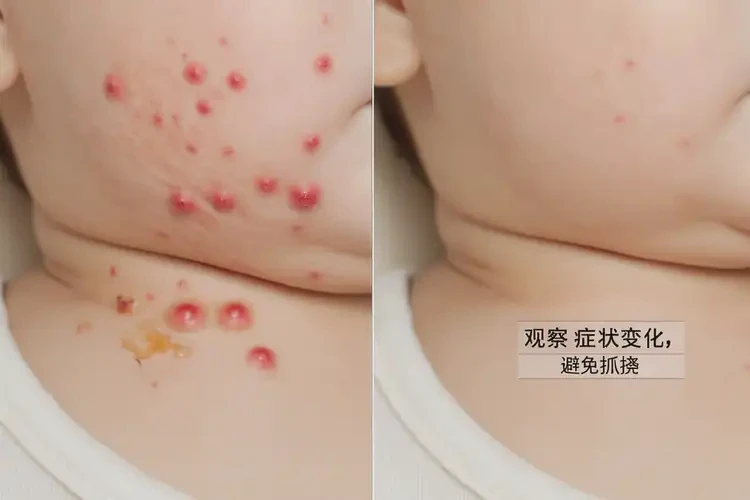 寶寶脖子上容易長濕疹不管它會自己痊愈嗎(圖1)