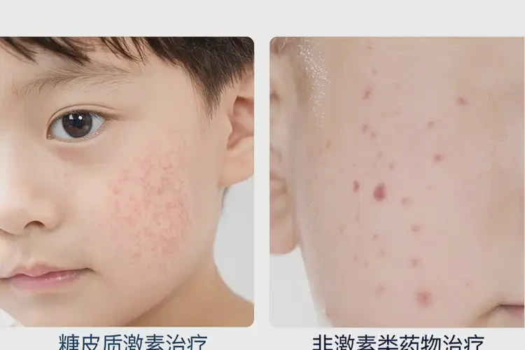 小孩屁股上偶爾起濕疹可不可以根治(圖1)