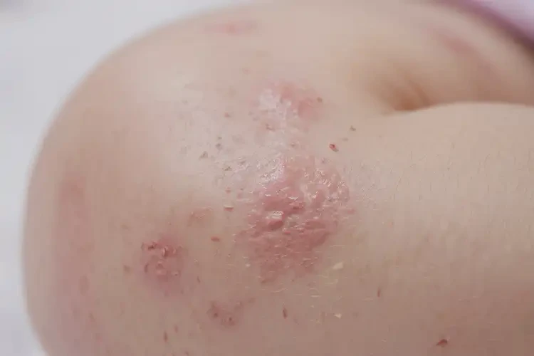 嬰兒大腿上經(jīng)常長(zhǎng)濕疹可不可以根治(圖3)