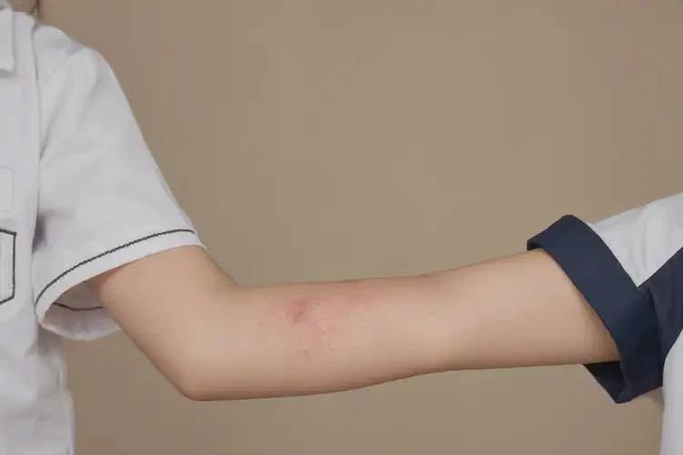 中學(xué)生手臂上容易長濕疹能靠自己自愈嗎(圖2)