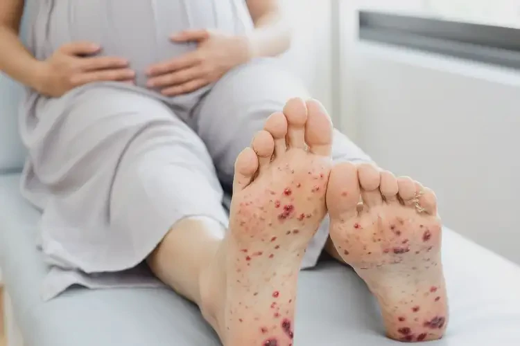 孕婦腳上容易長(zhǎng)濕疹不管它會(huì)自己痊愈嗎(圖4)