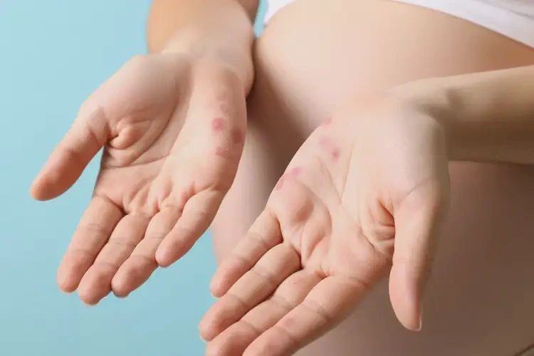 孕婦手上偶爾起濕疹可不可以根治(圖1)