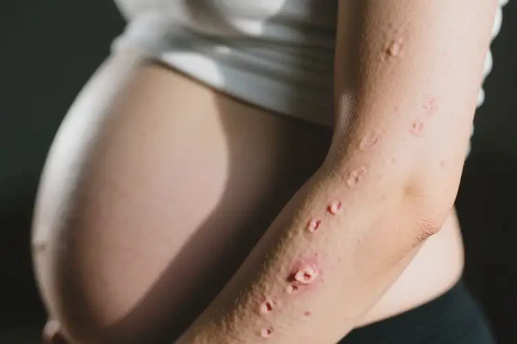 孕婦手臂上經(jīng)常起濕疹不管它會(huì)自己好嗎(圖2)