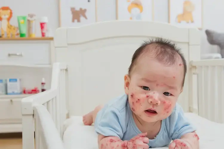 寶寶四肢容易起濕疹可不可以根治(圖4)
