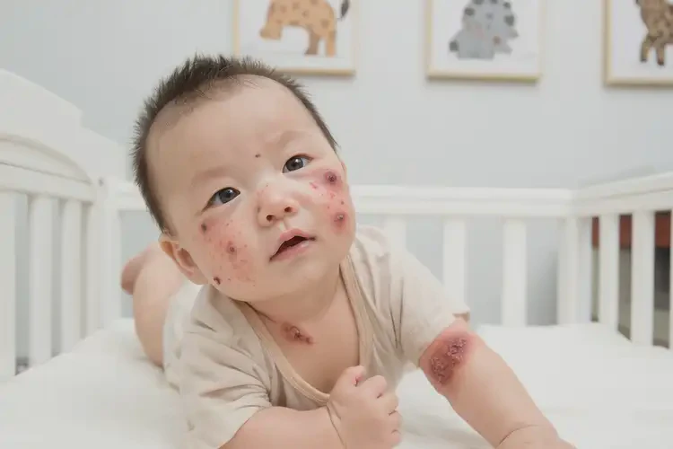 嬰幼兒屁股容易長濕疹可不可以根治(圖4)