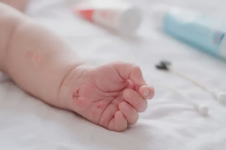 小兒手上偶爾起濕疹能徹底自愈嗎(圖4)